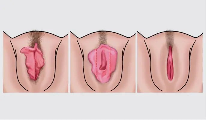 Ilustração clínica das etapas do Lift HD Íntimo – Dra. Bruna Ghetti