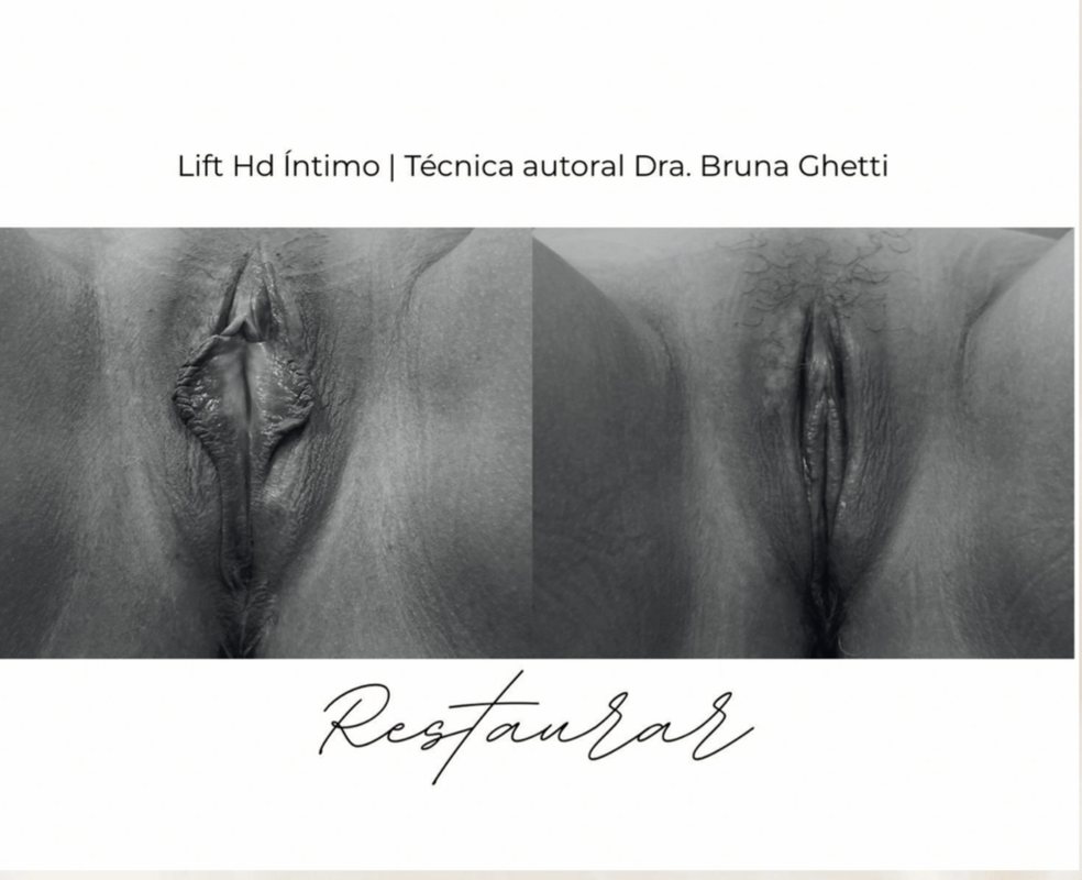 Resultado real – Lift HD Íntimo. Técnica autoral Dra. Bruna Ghetti.